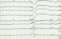 cra-EEG