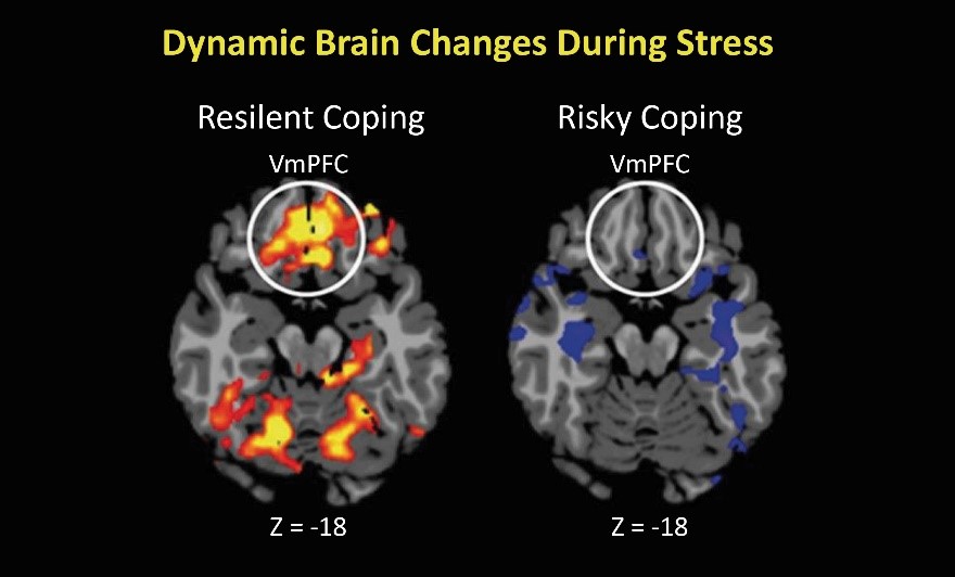 Neurofeedback Training for Burnout